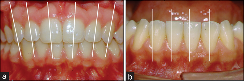 (a) Mesial distal inclinations of the upper anterior teeth. (b) Lower incisors in a mesial-distal inclination or in a vertical relationship