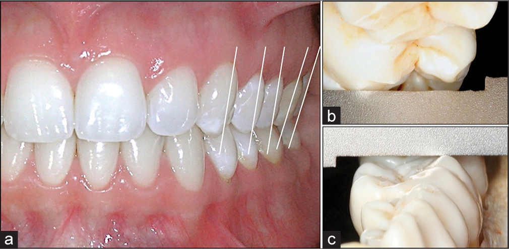 (a) Posterior upper torque en mass with canines, premolars and molars with the same inclination, or molars slightly more. (b) In the maxillary arch, the straight edge should contact the lingual cusps of the maxillary molars and premolars. The buccal cusps should be within 1 mm of the surface of the straight edge. (c) Progressive posterior lower torque. A straight edge should contact the buccal cusps of contralateral mandibular molars. The lingual cusps should be within 1 mm of the surface of the straight edge