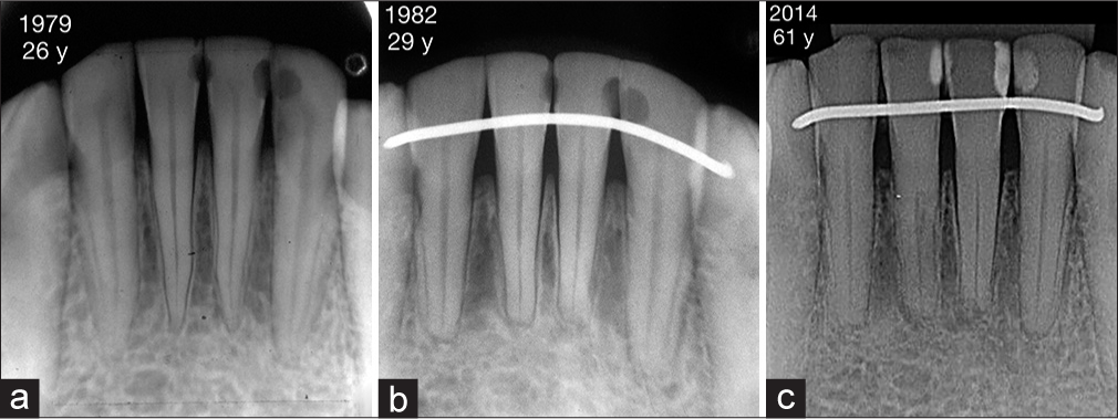 With a normal oral health care it is possible to maintain a lower fixed retainer for many years. (a) A patient at the beginning of treatment in 1979 with 26 years. (b) Lower fixed retainer bonded in 1982, with 29 years old. (c) A 3 - 3 lower retainer in 32 year follow-up