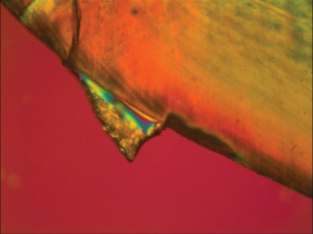 Representative lesion of the control group (Transbond XT) under polarized light microscopy