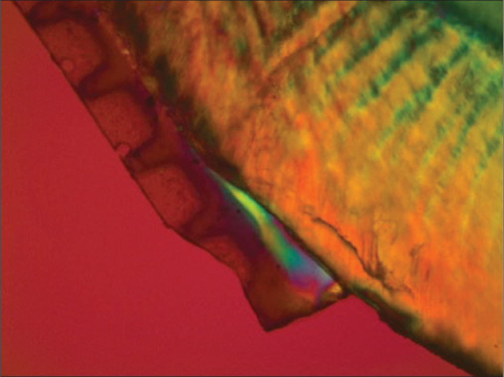 Representative lesion of ACTIVA under polarized light microscopy