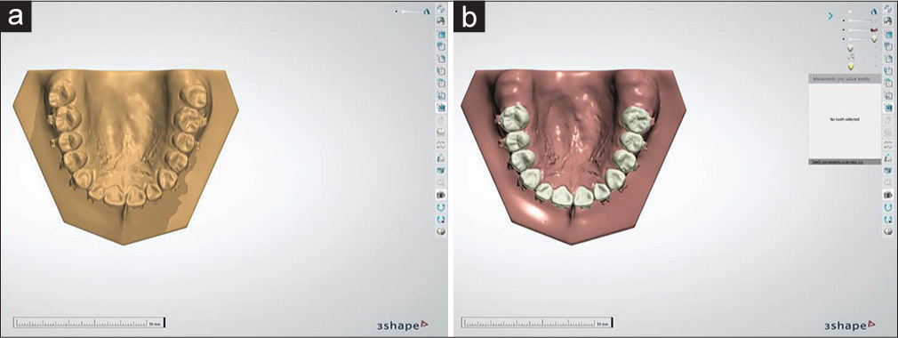 Three-dimensional digital maxillary model preparation using Ortho Analyzer software. (a) The original scanned model. (b) The digitized model with the second maxillary molars cut off