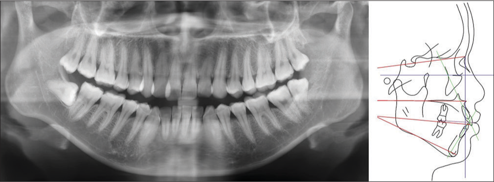 Pretreatment panoramic radiograph (left) and lateral cephalometric tracing (right)