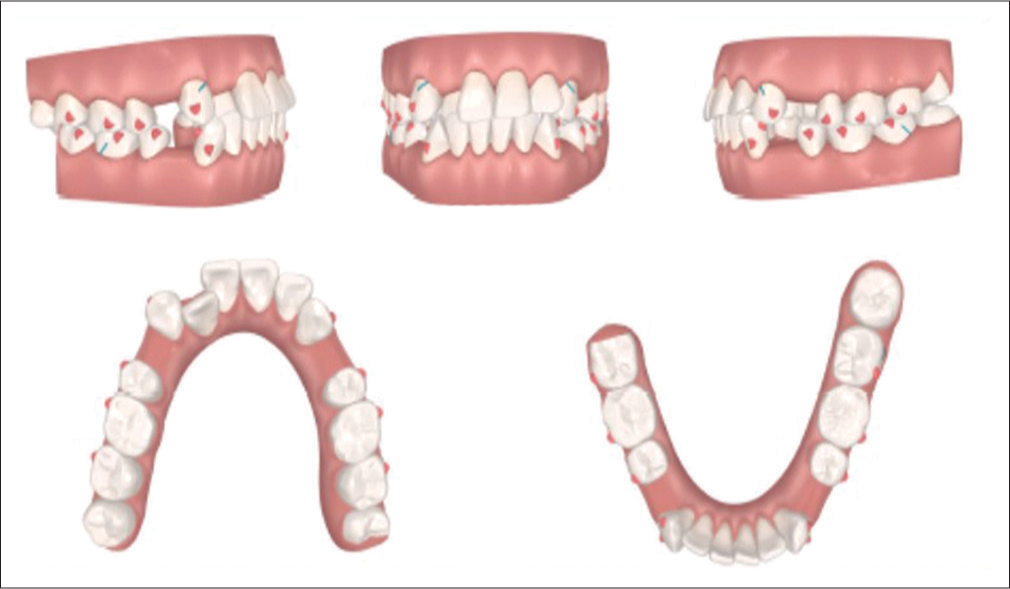 Pretreatment ClinCheck treatment Plan