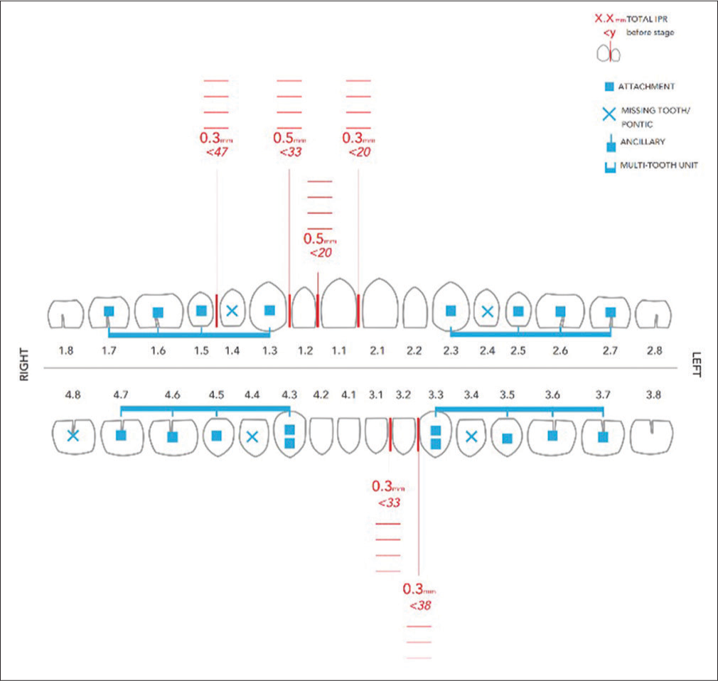 Placement of SmartForce features (specialized attachments) of the Invisalign G6 solution and use of interproximal reduction during the initial treatment phase