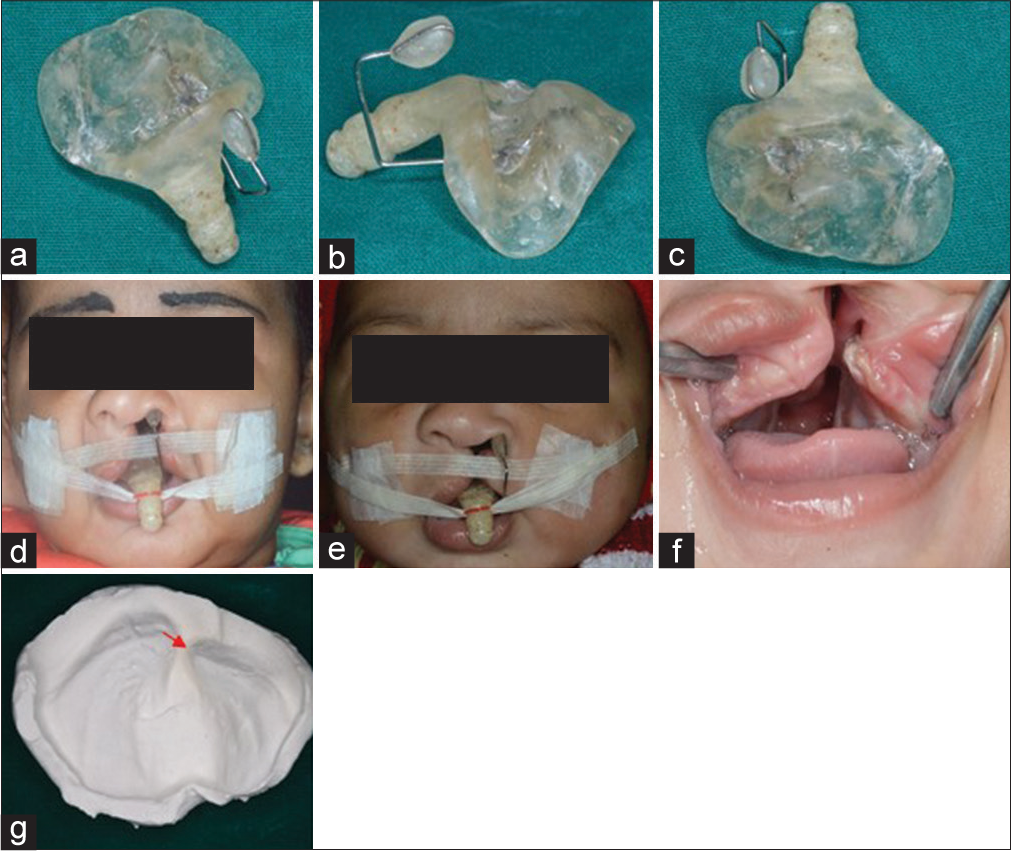 (a-d) Nasoalveolar molding plate with nasal stent, extraoral picture with nasoalveolar molding plate having stent, (e) extraoral postnasoalveolar molding, (f) intraoral, (g) cast postnasoalveolar molding with reduced cleft size to 3 mm