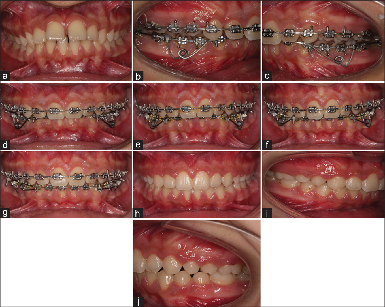 (a) A 16-year-old female patient with proclined upper incisors, lower incisors in contacted with palatal mucosa and deep bite. (b-d) Application of the double-sided intrusion spring at the 8th month of the fixed orthodontic treatment. (e-g) Treatment sequences at the 2nd, 3rd, and 7th month after the application of the double-sided intrusion spring. (h-j). After 24 months of total treatment time