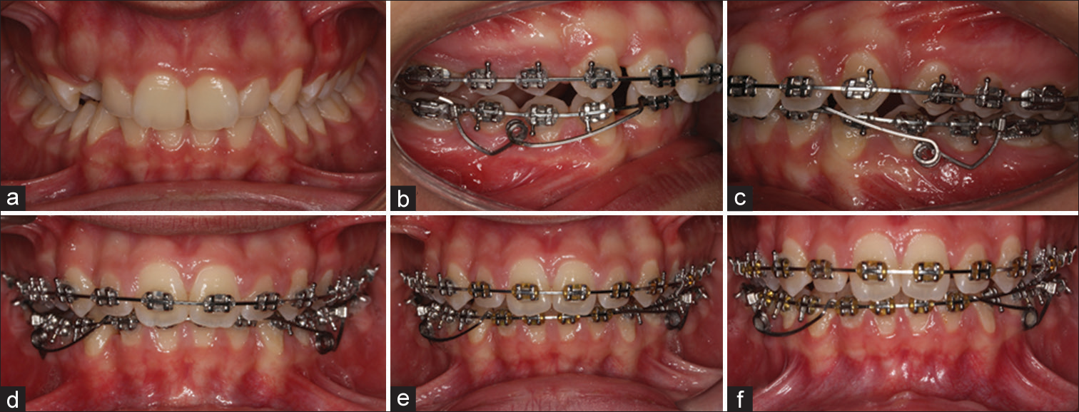 (a) A 16-year-old female patient with class II molar relationship, increased curve of Spee at the lower arch and deep bite. (b-d) Application of the double-sided intrusion spring at the 6th month of the fixed orthodontic treatment. (e and f) Treatment sequences at the 2nd and 4th month after the application of the double-sided intrusion spring