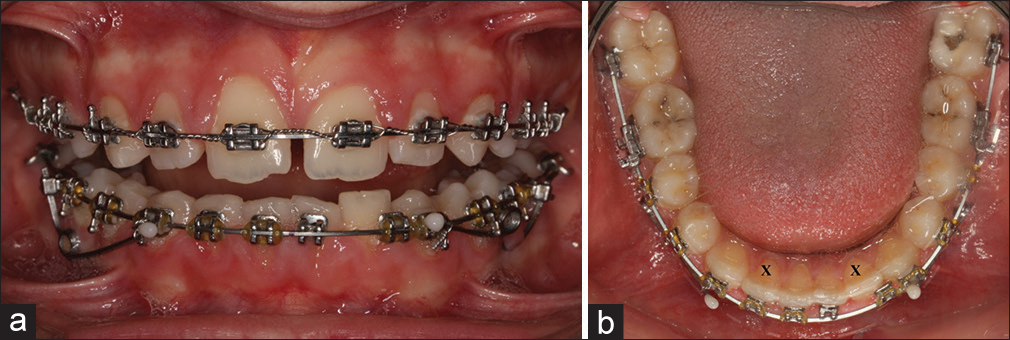 (a and b) Patient who was applied intrusion spring, had lower left lateral incisor bracket failure between the consecutive appointments. Intrusion of the teeth adjacent to the lower left lateral tooth can be observed. In addition, it cannot be said remarkable tooth protrusion when two lateral incisors are compared with each others
