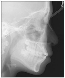 Pre-treatment lateral cephalometric radiograph.