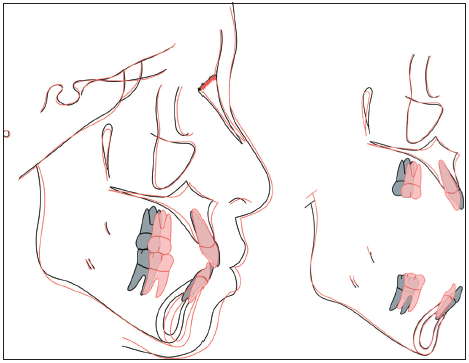 Initial (black) and final (red) cephalometric tracings are superimposed on the anterior cranial base (left) and the skeletal structures of the maxilla and the mandible (right).