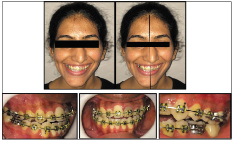 0.022” slot MBT prescription brackets and maxillary and mandibular 0.019 × 0.025” SS archwires in place.