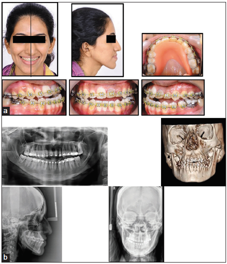 (a) Maxillary and mandibular arches prepared for surgery and correction achieved with guiding plate. (b) Radiographs showing the pre- surgical condition.