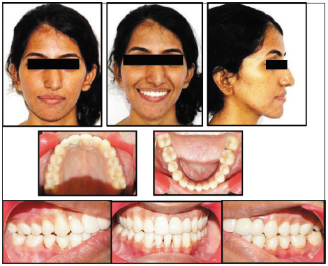 Extraoral and intraoral photographs, after removal of the appliance.