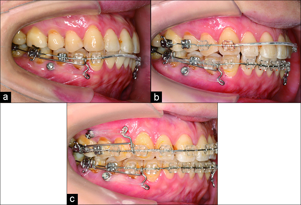Progressive intraoral photographs.