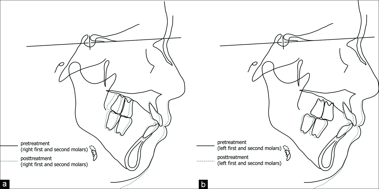 Superimposition of pretreatment and post-treatment lateral cephalometric radiographs. (a) Superimposition of right molars. (b) Superimposition of left molars.