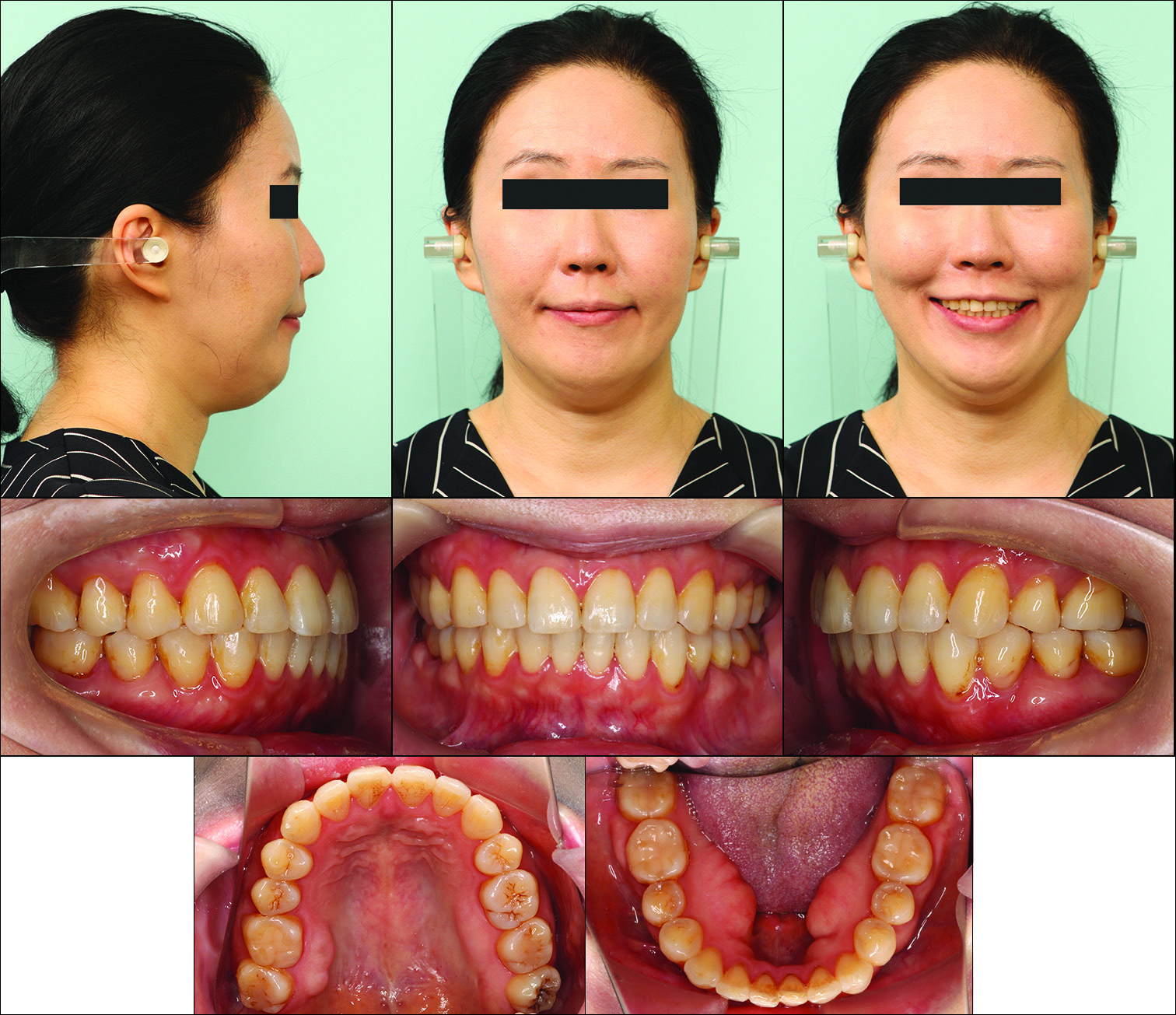 Facial and intraoral photographs after 29 months of retention.