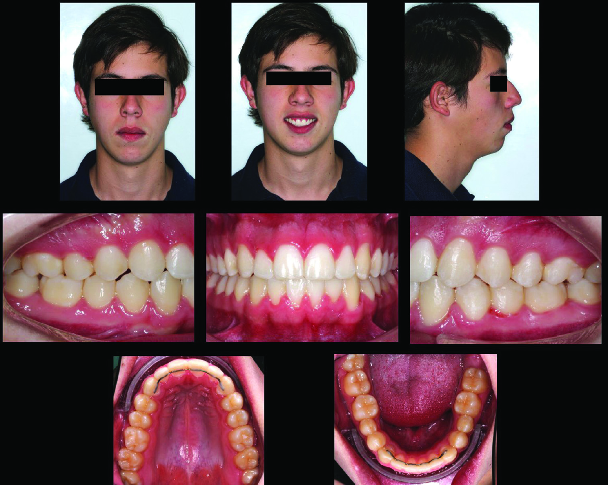 Final records of the patient. The treatment was completed in 21 months using Insignia