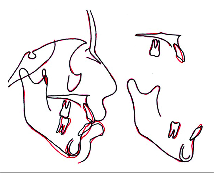Superimpositions showing the increase of the interincisal angle.