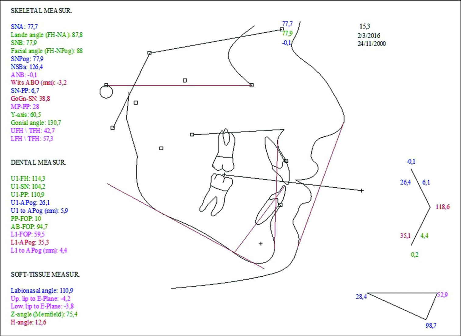 Initial cephalometric values confirming the increased GoGn-SN angle and mandibular plane angle. ANB at –0.1° and Wits at −3.2 mm. Upper and lower lip retrusive to facial profile.