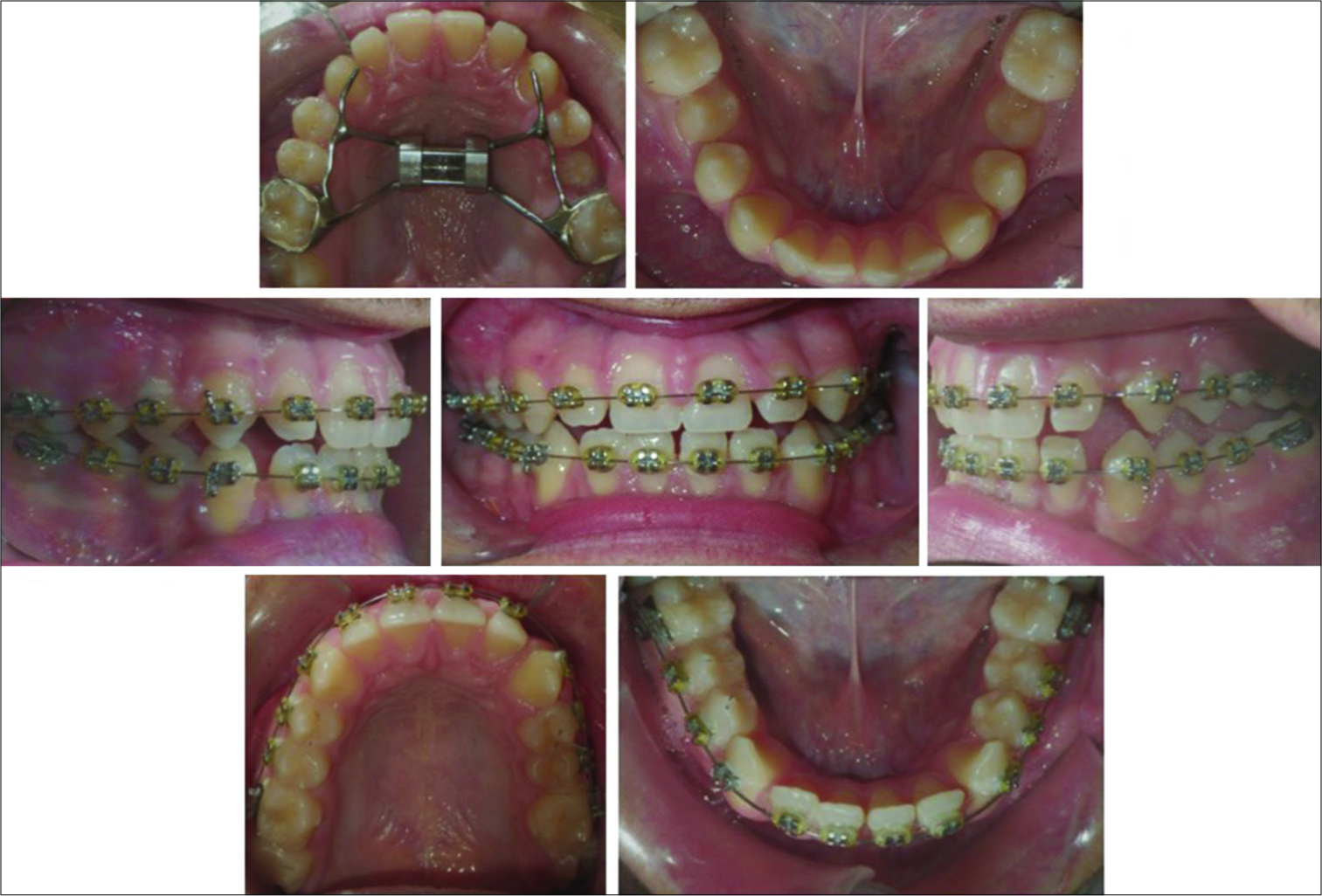 Hyrax appliance to correct the posterior crossbite. Fixed appliances in progress, used after the hyrax appliance and the surgical exposure and luxation of the upper left second molar. The lower third molars were also extracted.