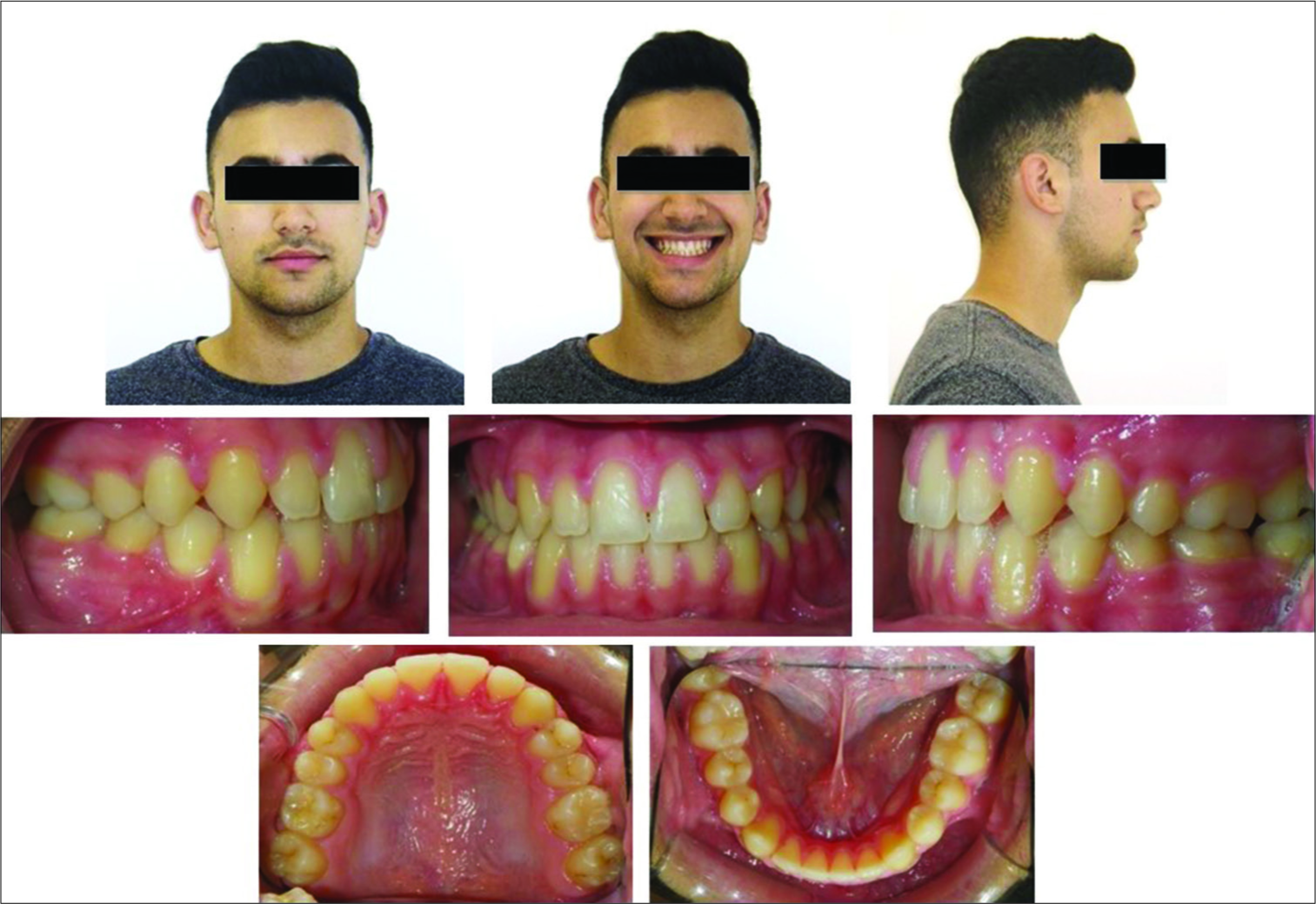 Final facial and intraoral photographs.