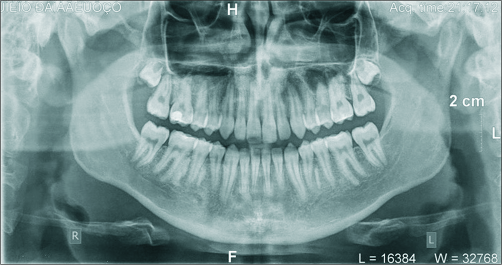 Panoramic examination in the end of treatment revealed that ideal root inclination and parallelism were achieved at the completion of treatment and the alveolar growth in the upper left and lower second premolar region, achieved its normal height.