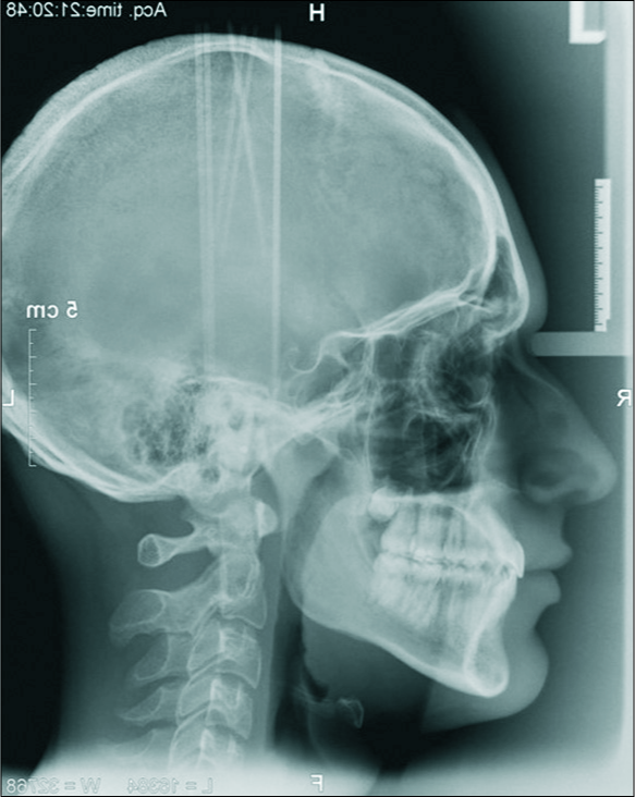 Final cephalogram age: 18 years, 5 months.