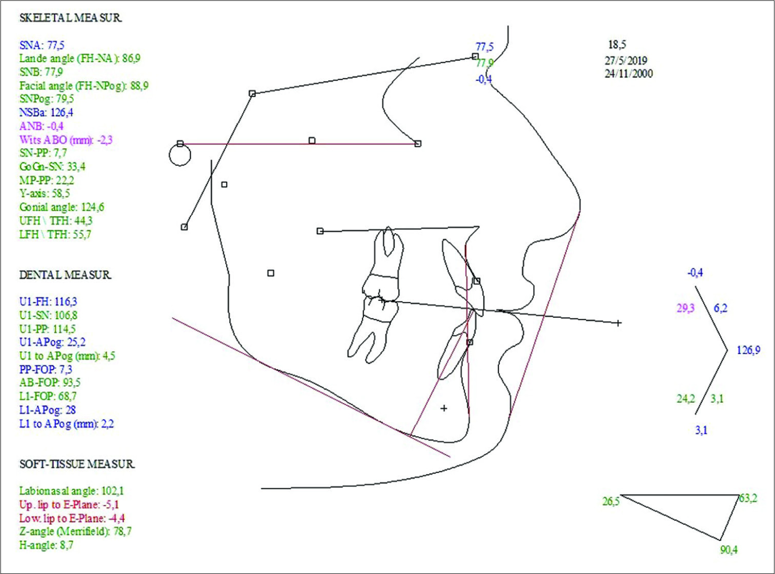 Final cephalometric values confirming decreased GoGn-SN angle and mandibular plane angles. Wits value decreased and further growth at pogonion counts for the decreased lip to E plane values.