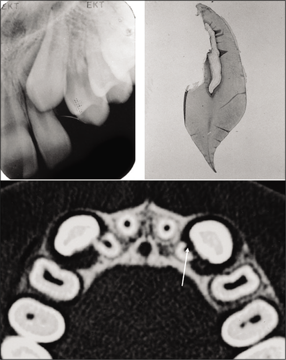 A 12-year-old boy with the canine overlapping the lateral incisor root. Severe root resorption can be seen on the 3D radiograph, white arrow, as well as on the extracted lateral incisor.