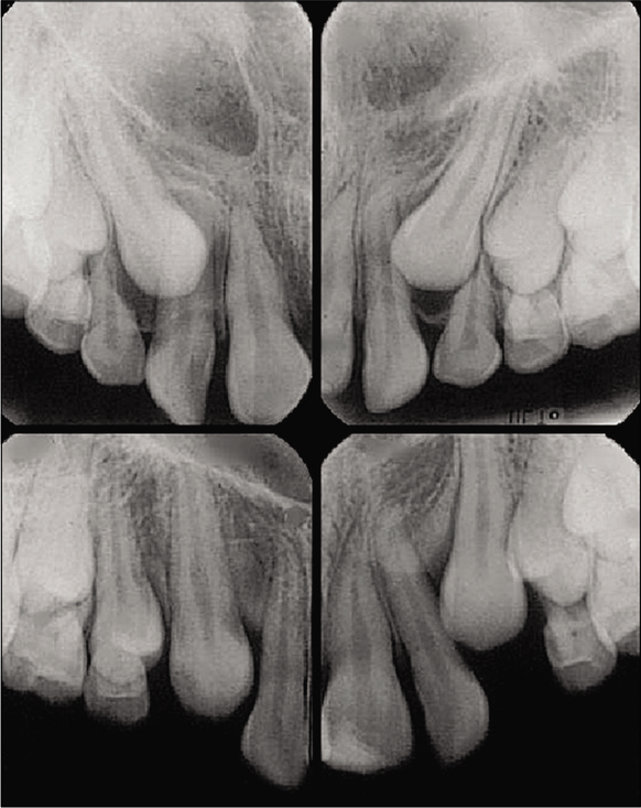 At the age of nine, the canines were not palpable buccally, but there was suspicion of palatal displacement. Intraoral radiographs were taken and the primary canines were extracted. Nine months later, a favorable change in the eruptive pathway was seen, leading to uneventful eruption.