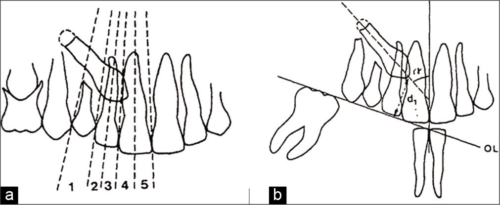 (a) Reference lines for the sectors of the canine crown on panoramic radiography. (b) Distance from the canine crown to occlusal plane d, and canine inclination to midline (alpha angle) also measured by panoramic radiography (Ericson and Kurol 1988).