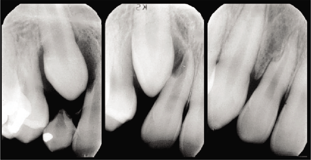 Normal eruption path of the maxillary right canine, but with a rare instance of resorption of the lateral incisor root. Subsequently, some repair was evident, and the lateral incisor functioned as a normal healthy tooth.