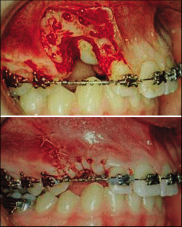 (Top) Ostectomy-decortication. A full-thickness flap is opened, bone is removed and cortical bone penetrations (decortication) surrounding the impacted canine. (Bottom) Flap closure over the surgical exposure (Ferguson et al., 2019).