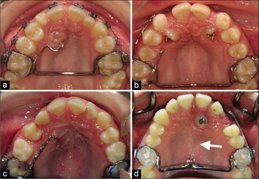 Different ways to distance the canine from the incisor before one can start traction out in the alveolar crest. One-way is to start with a transpalatal arch for anchorage and solder a sectional arch with a loop for an elastic band (a) or place heavy wires soldered to the bands. These wires can be 0.8 or 0.9 mm and provided with eyelets. With this appliance, it is easy to change the direction of the traction with an elastic band (b and c). For the direction straight backwards, solder a loop directly on the transpalatal arch and add an elastic band, white arrow (d).