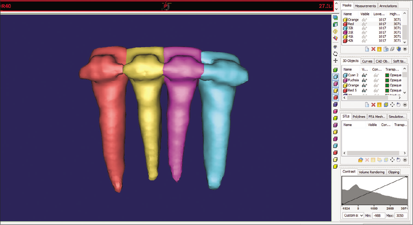 Segmentation and reconstruction of the incisor teeth. Each tooth was color coded. Segmentation was performed in four steps: Selecting the threshold value, editing the mask in 3D, editing the mask in 2D, and reconstructing in 3D.