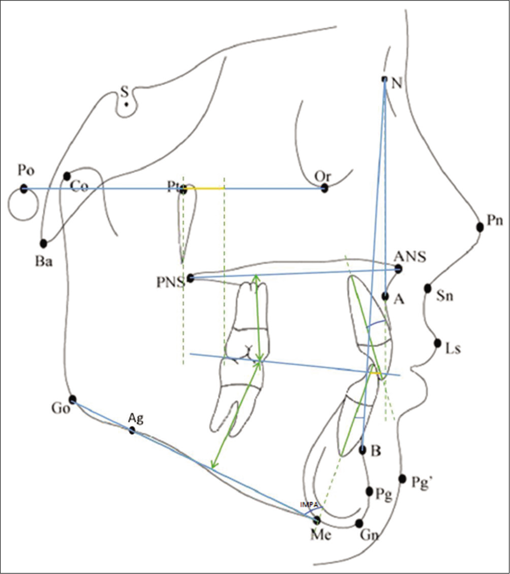 Dentoalveolar parameters (1)- A) U1-NA, B) L1-NB, C) IMPA and D) Overjet. Dentoalveolar parameters (2)- A) U6-NF, B) U6-Ptv and C) IMPA.