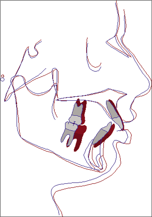 Typical overall superimposition (along SN at S) of a Group A patient: Blue (pre-treatment) and red (post-treatment).