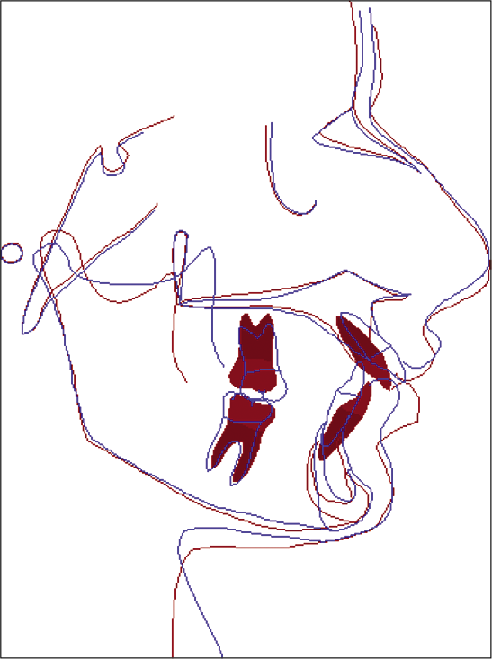 Typical overall superimposition (along SN at S) of a Group B patient: Blue (pre-treatment) and red (post-treatment).