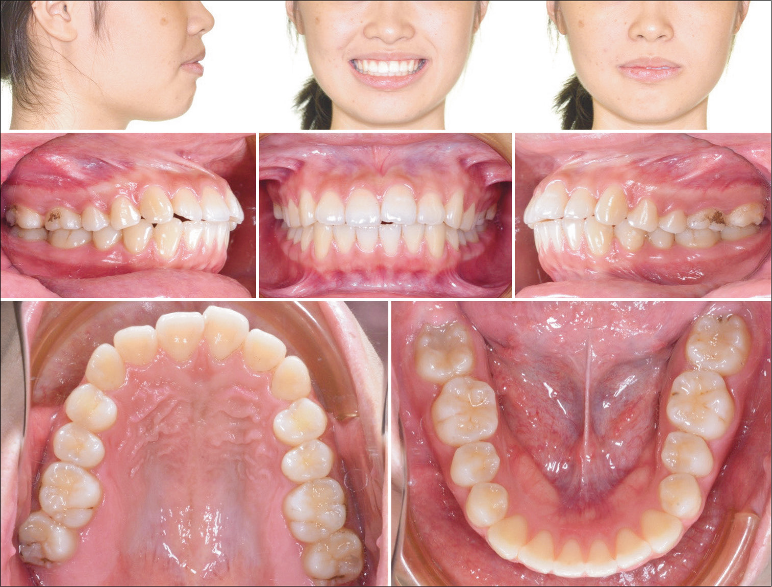 Pre-treatment extraoral and intraoral photographs.