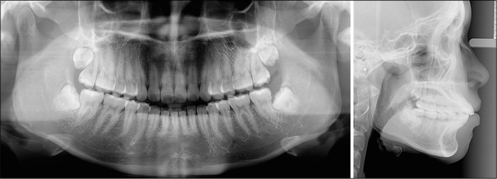 Pre-treatment panoramic radiograph (left) and lateral cephalometric radiograph (right).
