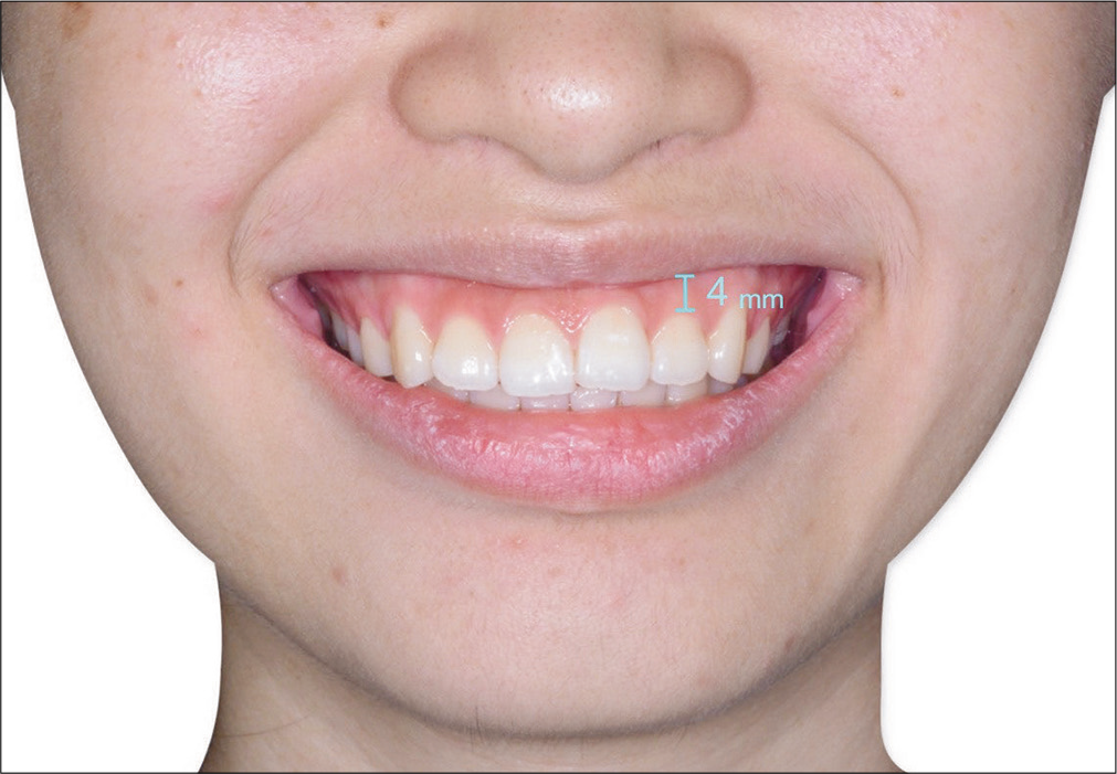 Pre-treatment extraoral photographs revealed patient’s gummy smile tendency. Note that the width of exposed gingiva is 4 mm superior to the U2s.