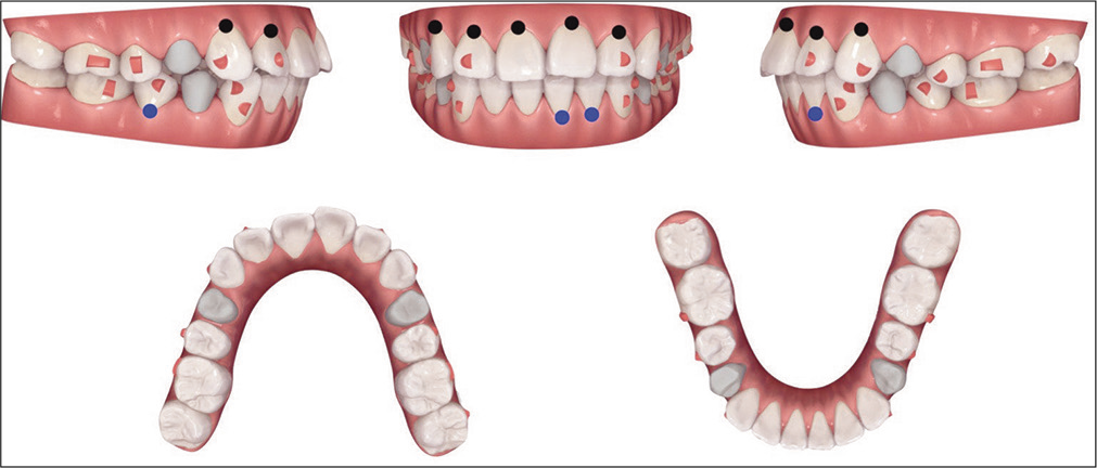 ClinCheck® treatment plan and prescribed attachments are shown for the initial phase of treatment. Blue dots indicate variably predictable tooth movement (2.5–3 mm intrusion for lower incisors; 4–6 mm root movement for LR5). Black dots indicate less predictable tooth movement (>3 mm intrusion for upper incisors; >6 mm root movement for UR3).