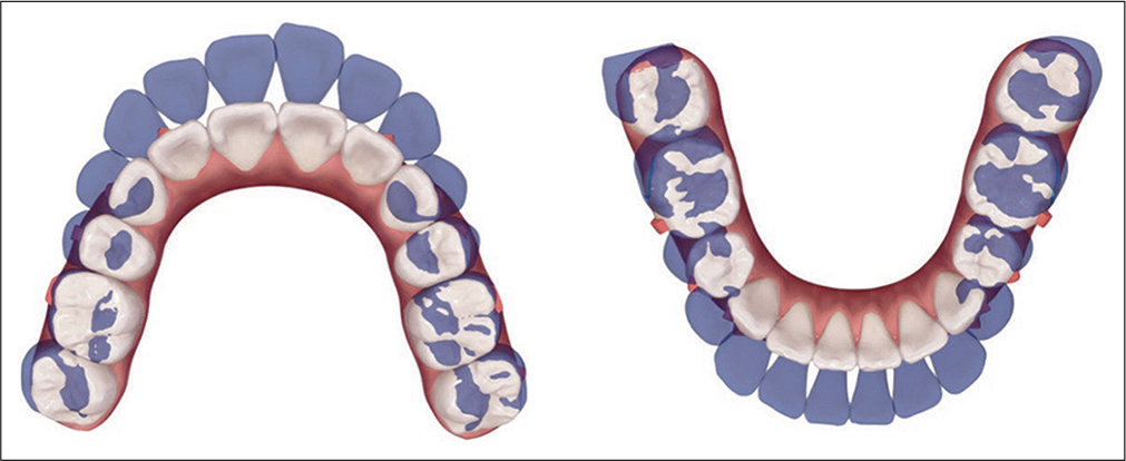 ClinCheck® initial phase treatment is projected by superimposition (blue: original tooth position; white: simulation of final tooth position) on dental landmarks that are programmed to be stable. Maximum anchorage is planned in the upper arch, consistent with more moderate anchorage for the lower arch. The anchorage requirements in both arches are quite challenging, and require TAD anchorage.