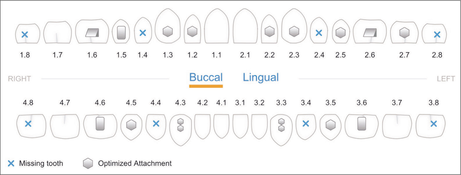 The initial phase of Invisalign® treatment utilizes SmartForce® features (optimized attachments in hexagon) for the Invisalign G6 solution to provide maximal posterior anchorage for distal translation of canines.