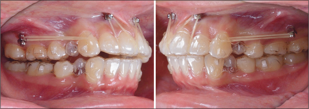 Intraoral photographs show the mechanics after OrthoBoneScrew® placement and the application of 3.5oz elastics for retraction of buccal segments and intrusion of the maxillary anterior segment.