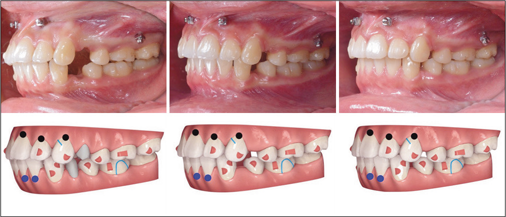 A progressive series of left buccal intraoral photographs show the progress of treatment compared to ClinCheck® simulations: Left 3 months, 10/45 aligners; center 6 months, 21/45 aligners; right 10 months, 32/45 aligners. Note a modified G6 attachment is specified for the UL3 to accommodate a precision cut for an elastic anchored by the IZC OBS. For the colored markings in the simulations, see Figure 4 for details.