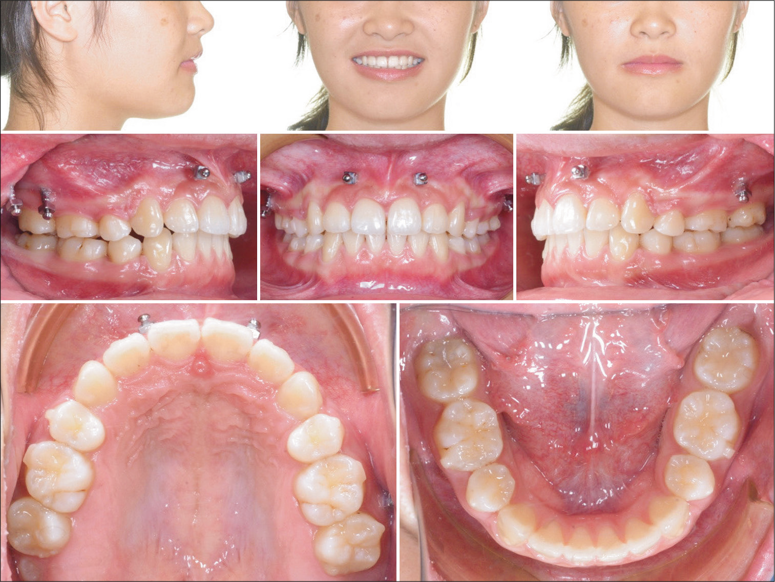 Extraoral and intraoral photographs show the outcome for the initial phase of aligner treatment. A canine Class II window (interocclusal space) distal to the UR3 cusp is noted.