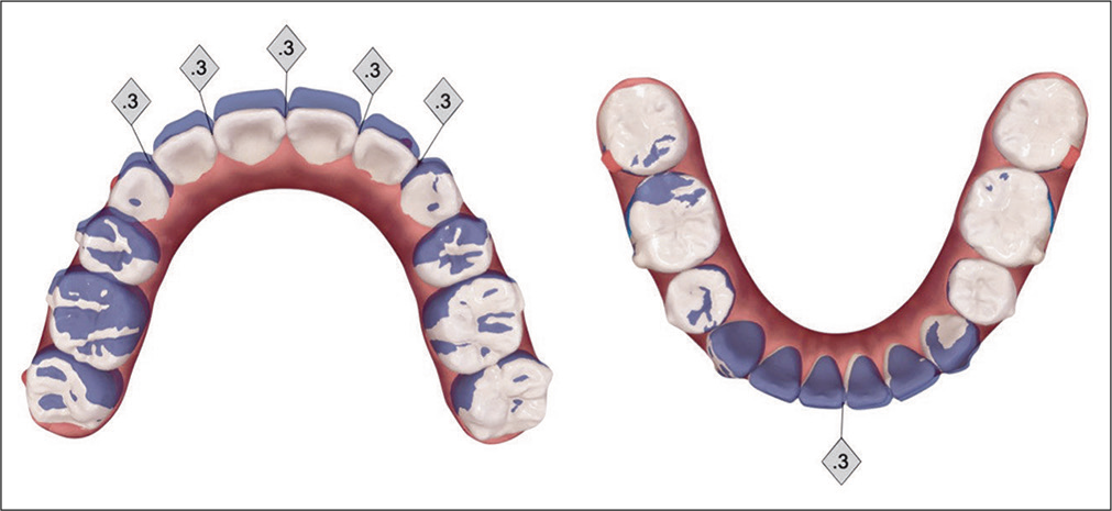 Refinement phase of treatment is programmed into ClinCheck® to retract the UR quadrant 1 mm (blue: original tooth position; white: simulation of final tooth position). IPR of 0.3 mm is planned for five sites in the maxillary anterior segment, but for only one site in the lower arch, to correct a perceived Bolton discrepancy.