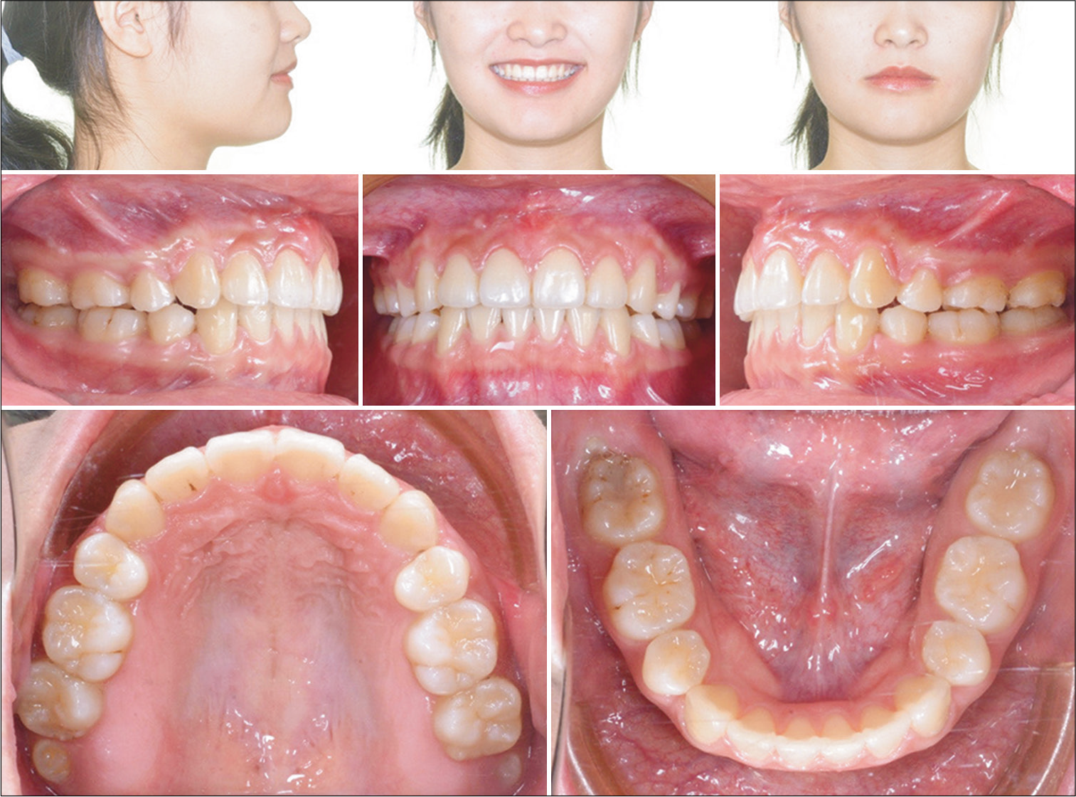 Post-treatment extraoral and intraoral photographs. Gingivoplasty as well as labial frenectomy were performed with diode laser at the completion of the treatment. Note the buccal segments are slightly Class II, but there is no overjet suggesting than more refinement of IPR was indicated in programming the refinement stage on ClinCheck®.